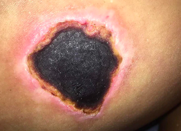 Horrifying photos reveal spider bite victim's 12-month ordeal after thigh  wound turns into 'CRATER