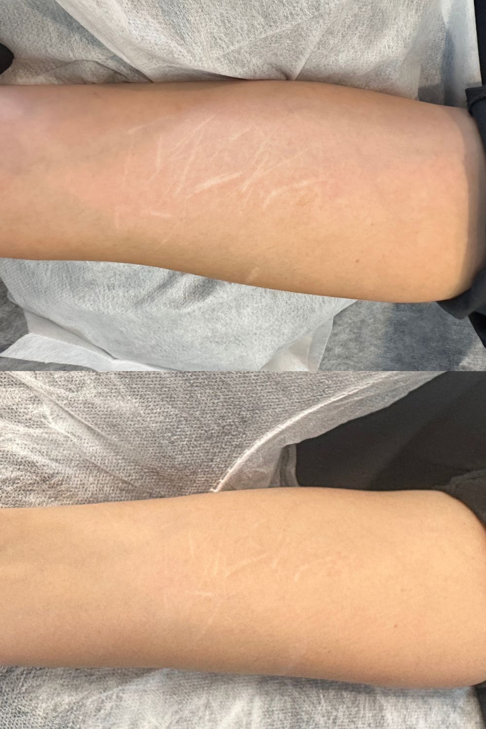 Scar camouflage tattooing in progress. Photo / Inkworks Studio