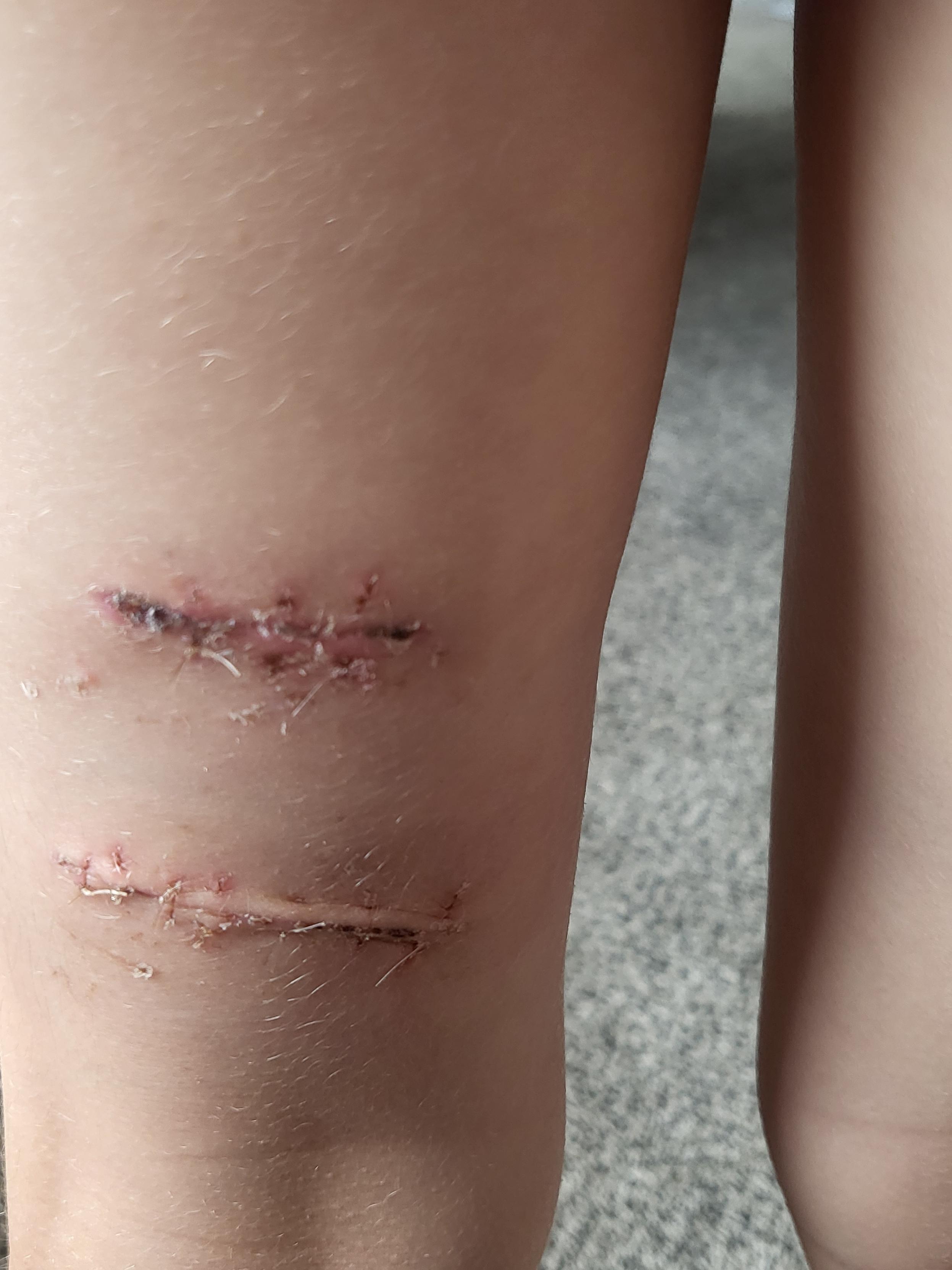 The bite marks on the back of Sienna Lewis' legs as they started to heal. Photo / Supplied