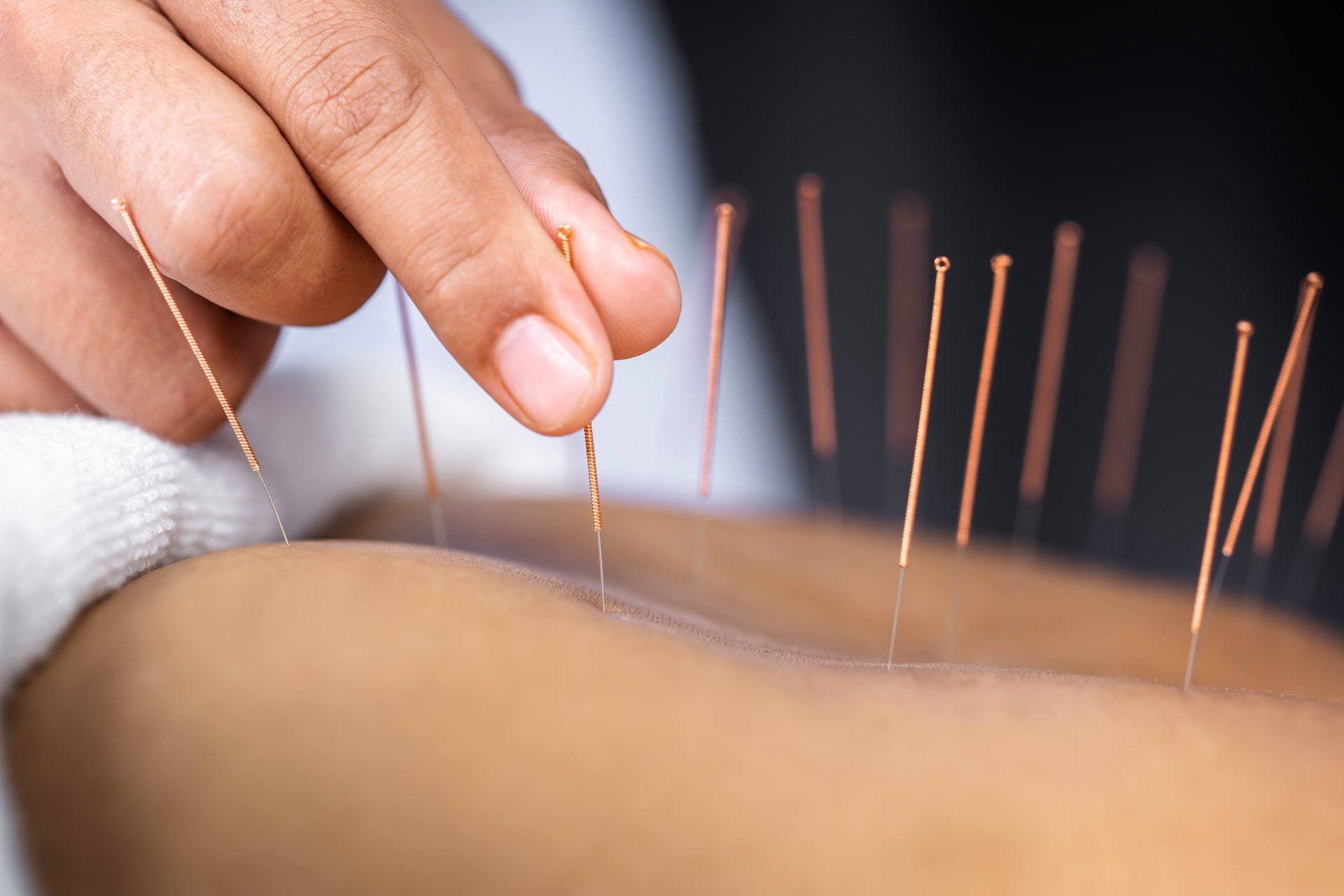 Acupuncture is said to stimulate the body's central nervous system. Photo/123rf