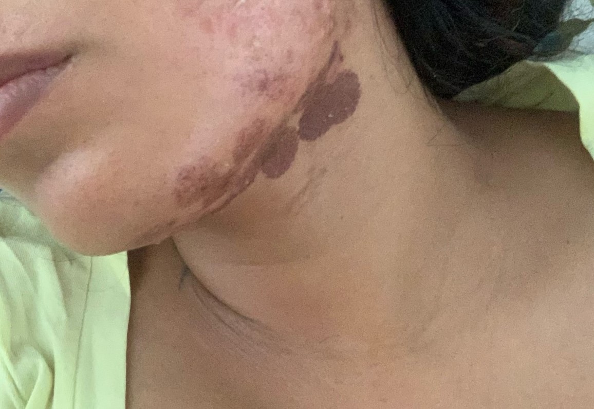 Laser horror story: Woman left with face burns after hair removal session -  NZ Herald