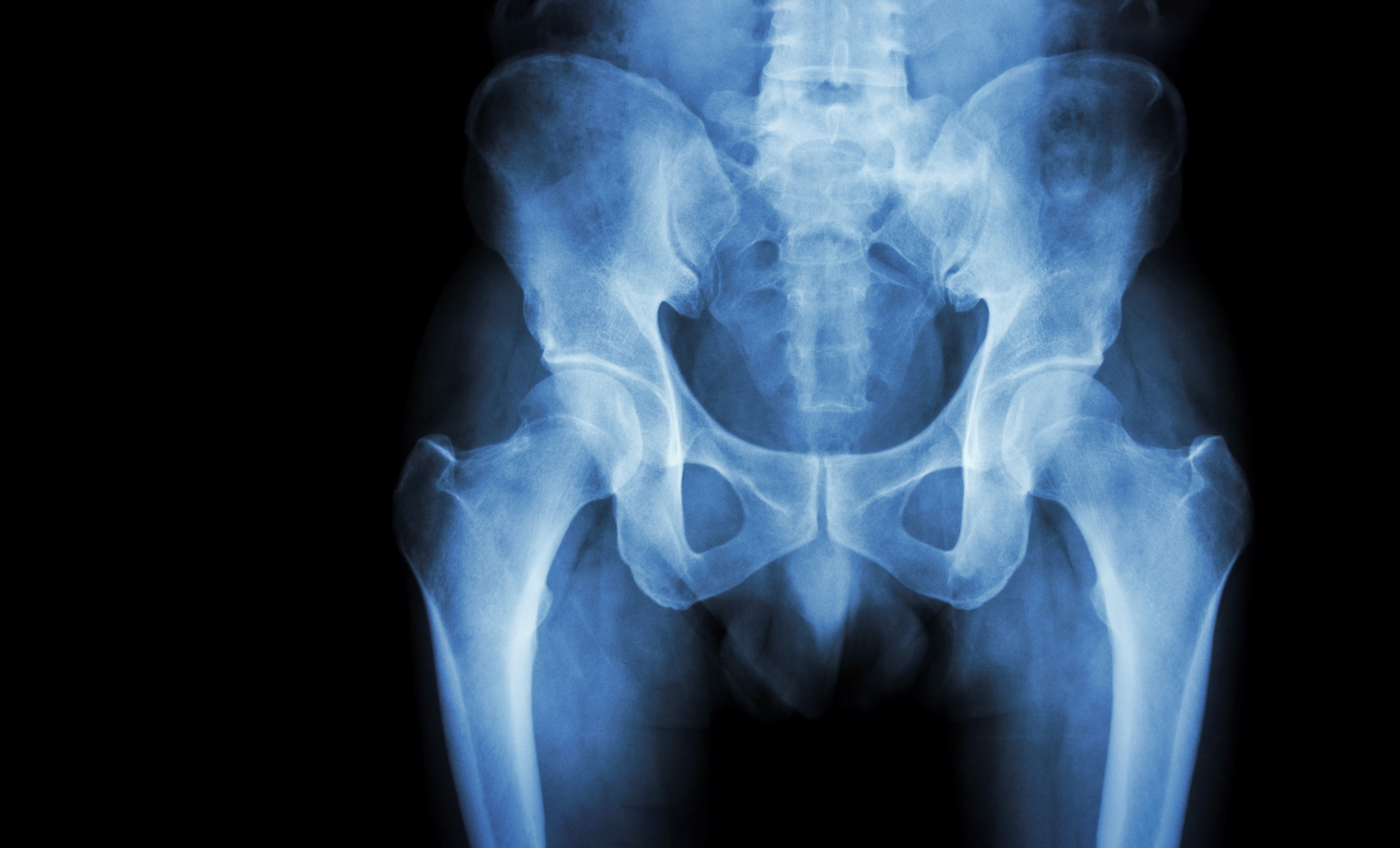 Global estimates show that up to a third of older adults who have suffered hip fractures will die within a year. Photo / Getty Images