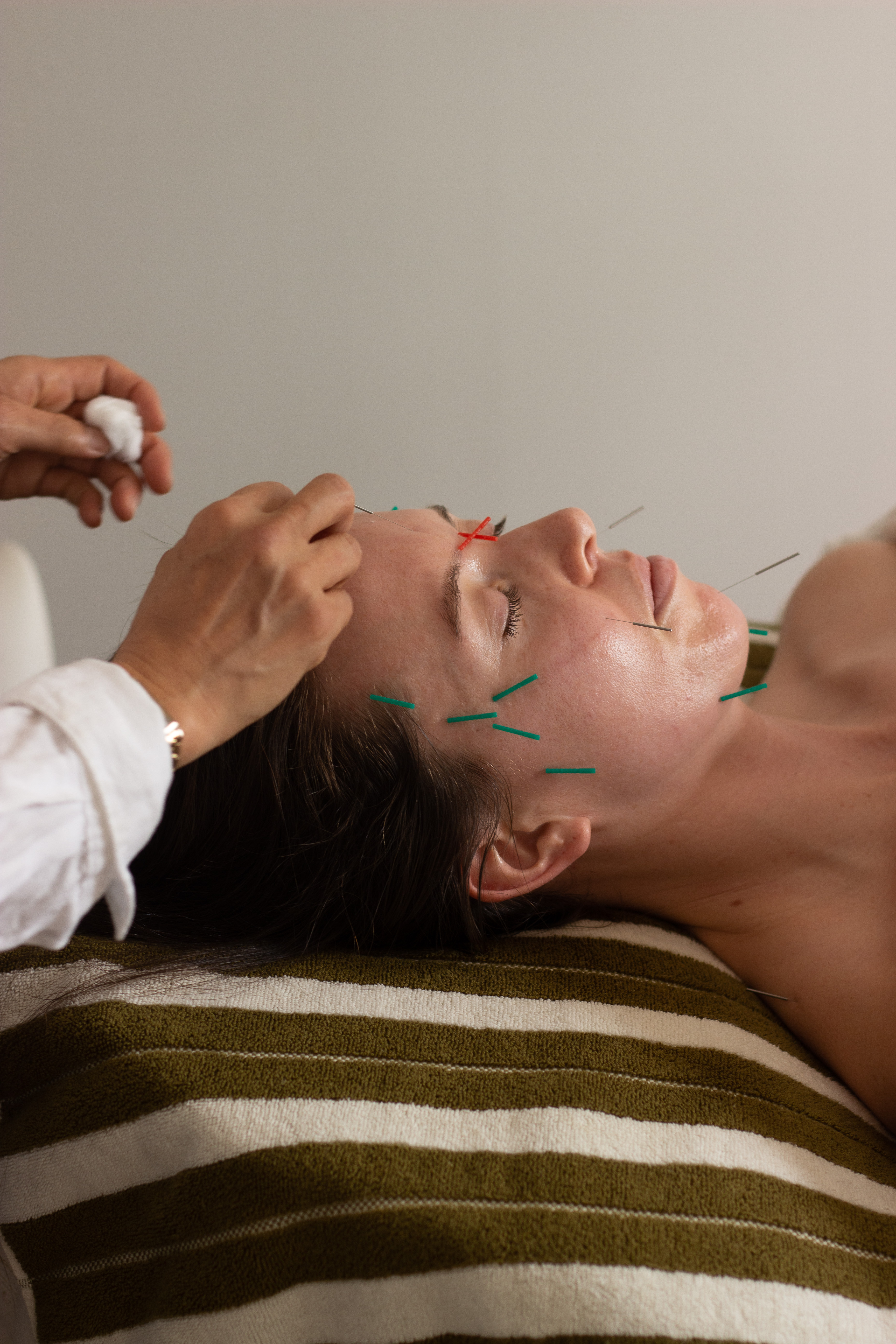 Acupuncturist Kiki Chen inserts micro-fine needles into specific acupuncture points in the face. Photo / Sophia Doak