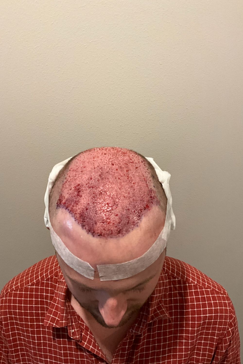 Immediately after the procedure, with some redness and swelling visible. Photo / Supplied