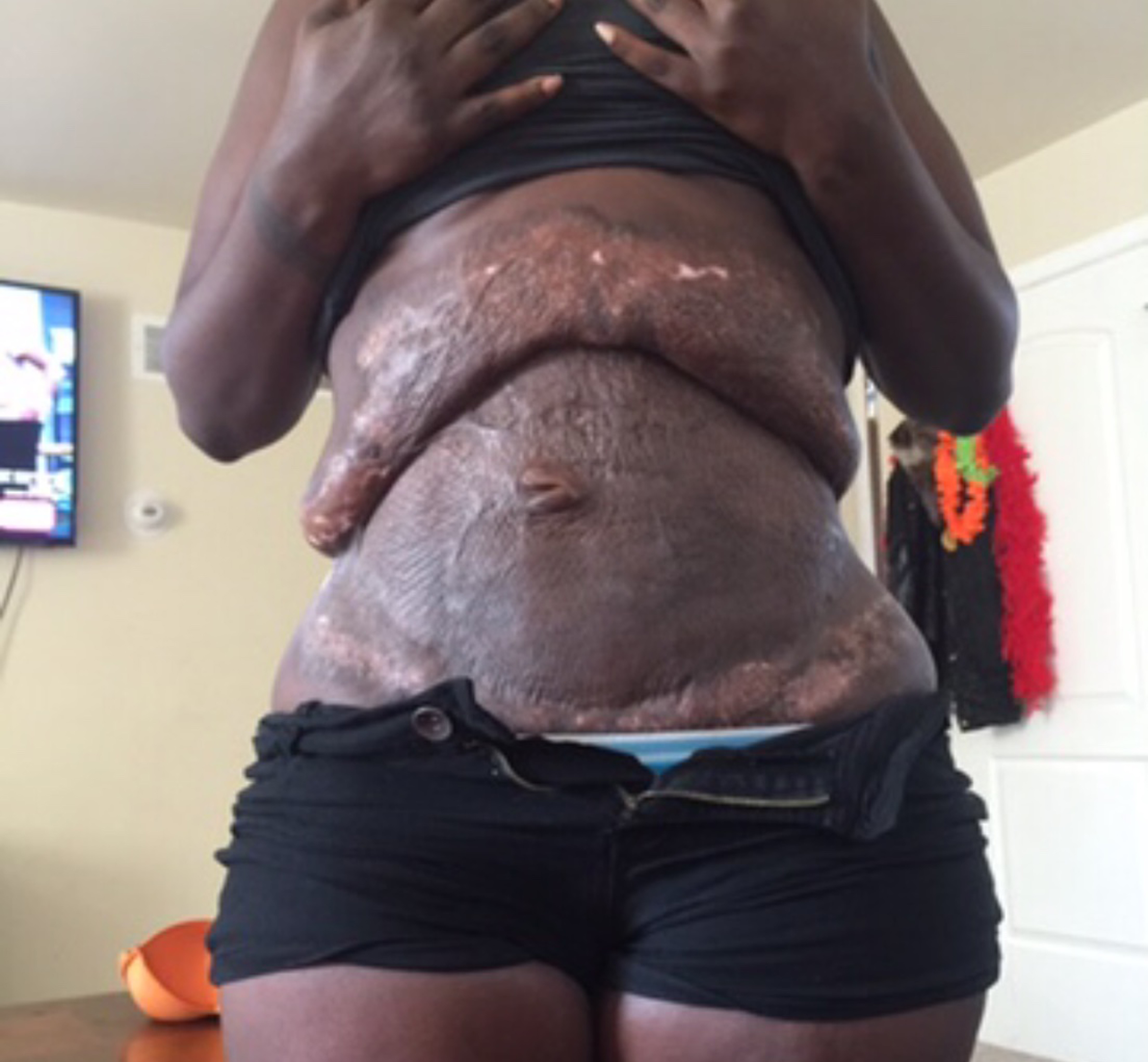 Botched' Features The Case Of A 'Mexican Tummy Tuck' And 'Grandma