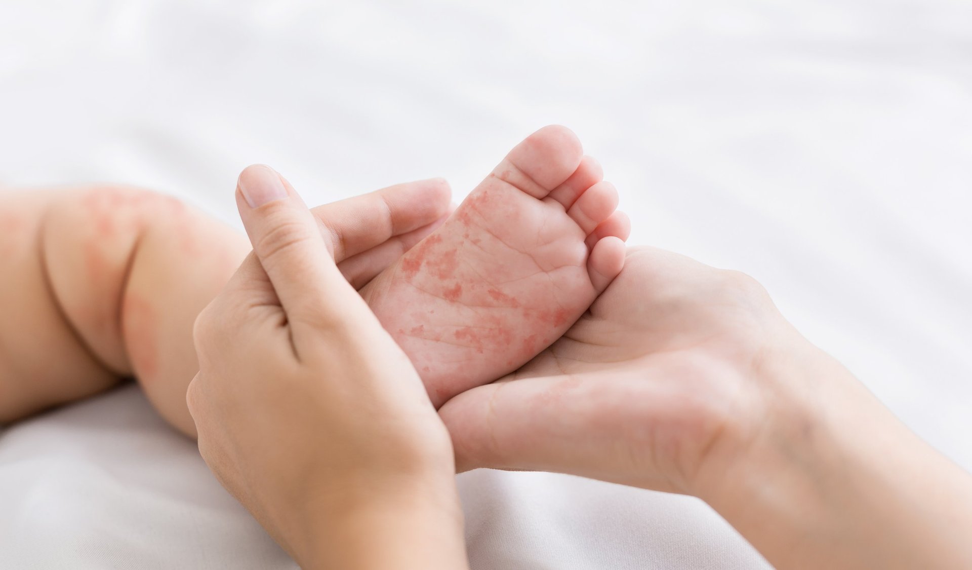New Zealand hasn't seen any reported cases of measles since early 2020. Image / 123RF