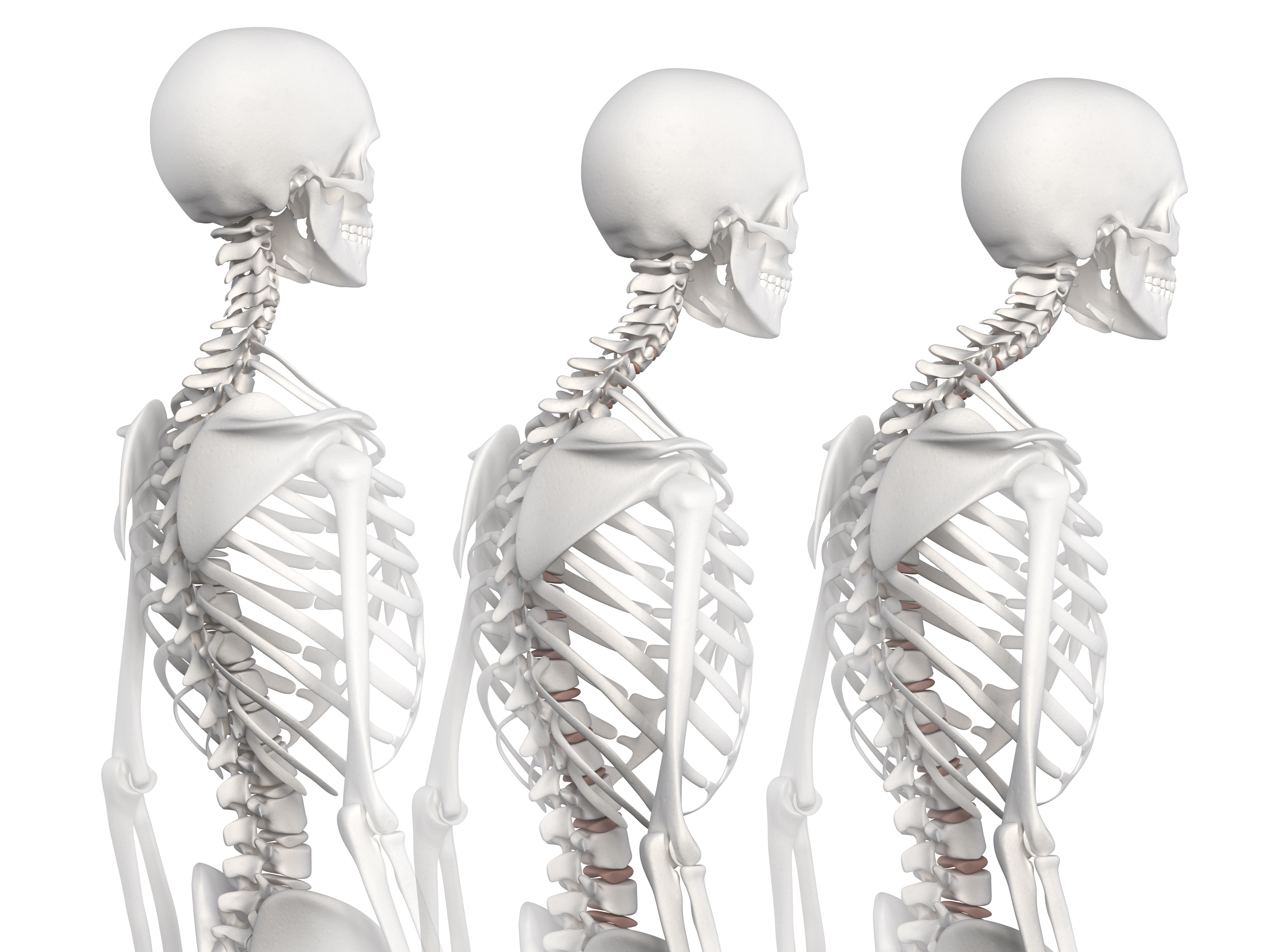 With no symptoms until a fracture, osteoporosis can be devastating. Photo / 123rf