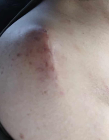 Stacey Penn had her rotator cuff torn during the incident. Photo / Supplied