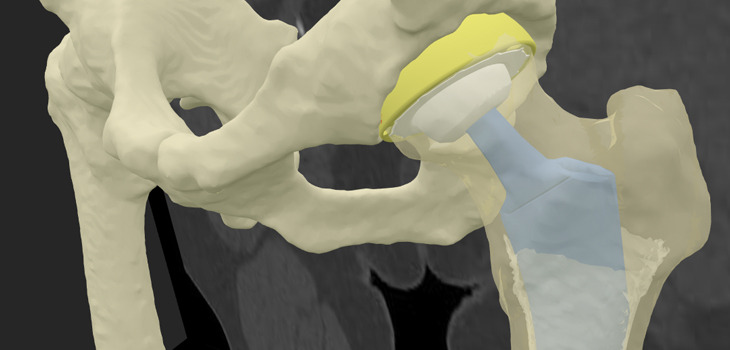Formus Labs' software creates a 3D, interactive model of a patient's joints, taking guesswork of the process of selecting the right size of orthopedic implants. Image / Supplied