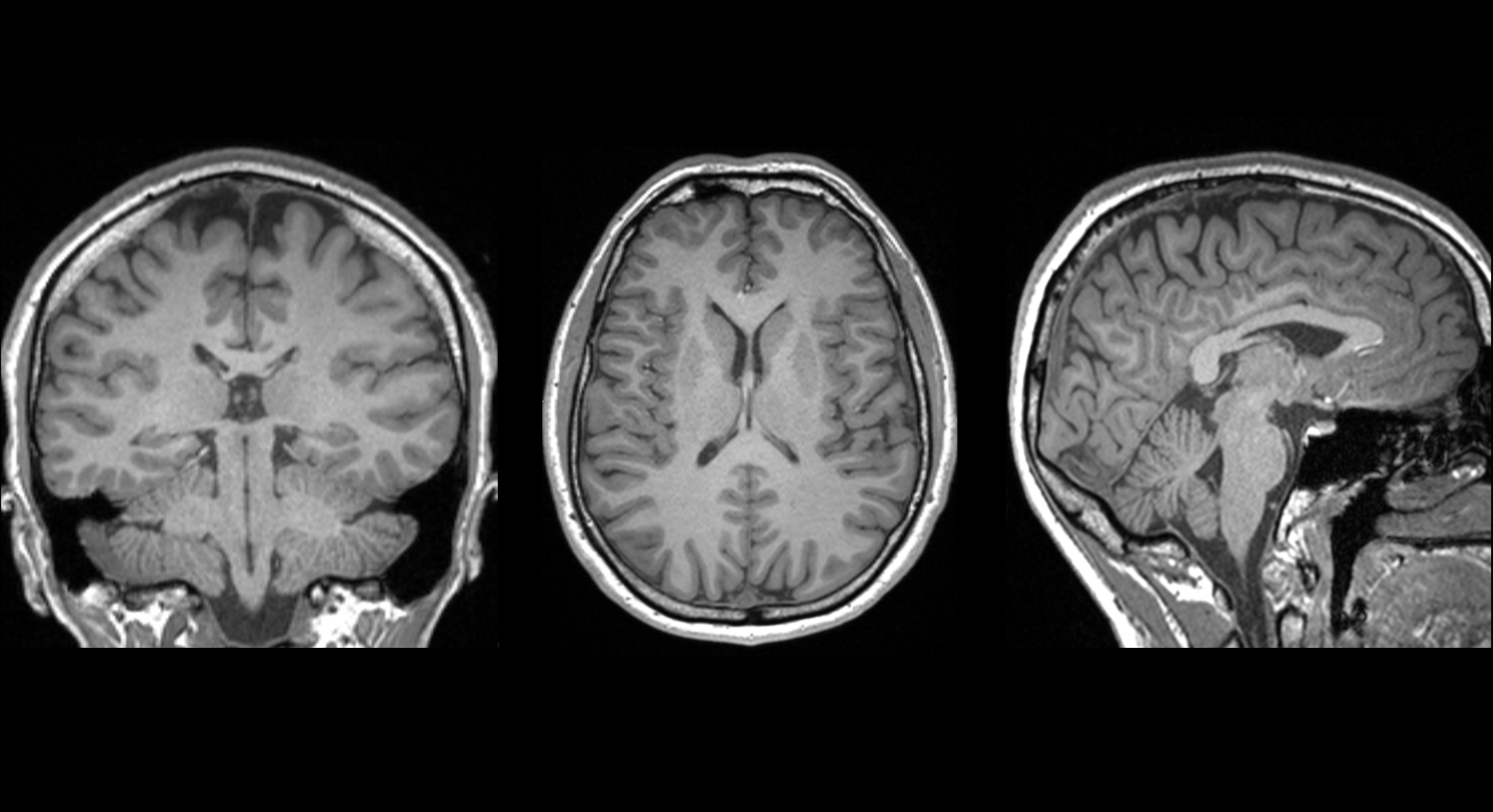 This image shows a brain scan used in an AUT-led study that revealed a telltale marker of mild traumatic brain injury. Photo / Auckland University of Technology