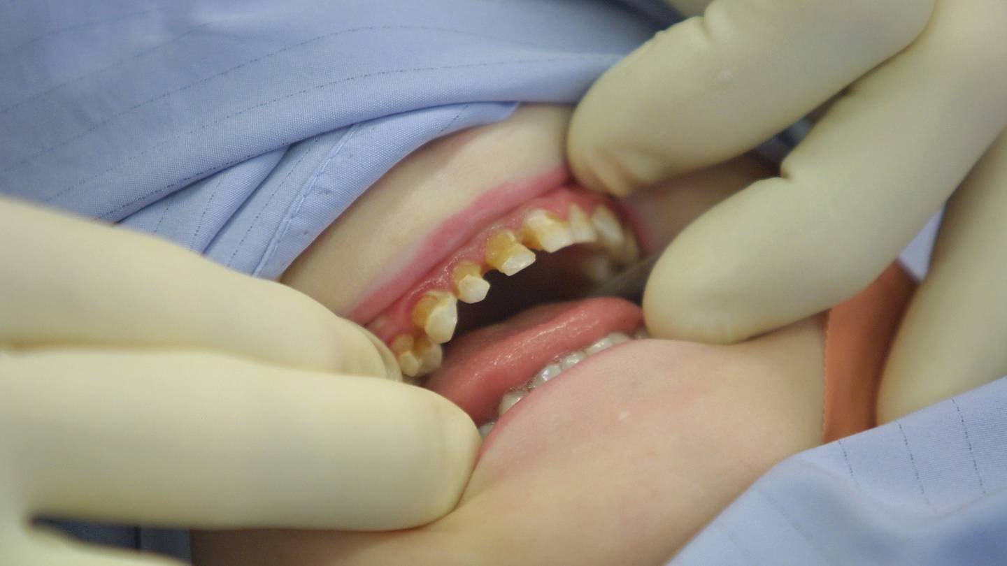 DHB data shows 60 per cent of Māori children in Porirua had decay in their teeth at age 5. Photo / File 