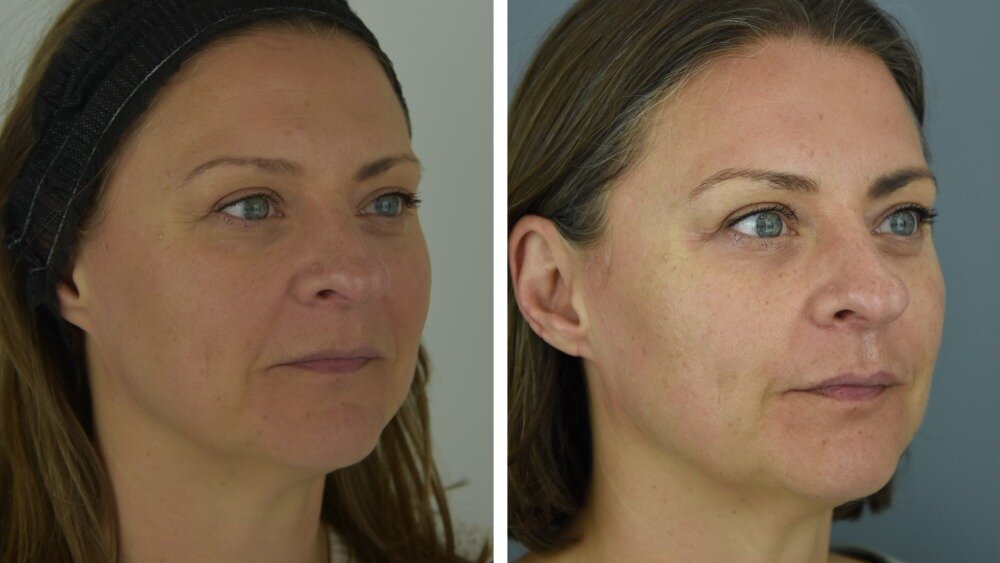 Stephanie Holmes' official photos taken before (left) and after (right) a four-month treatment course of Sunekos at The Face Place.