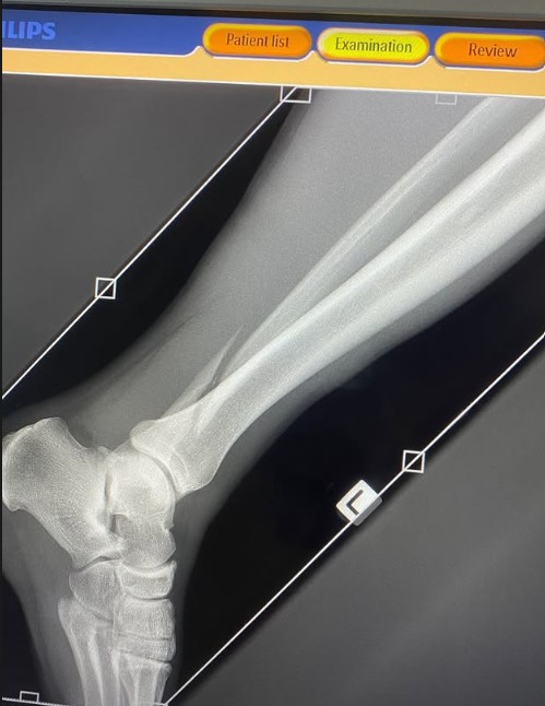 Noah Hotham's injury was posted on his Instagram page.