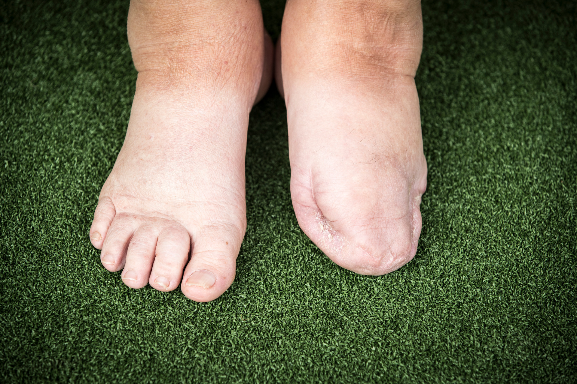 Most diabetic amputations in New Zealand are classified as 'minor' (below ankle). Photo / Michael Craig