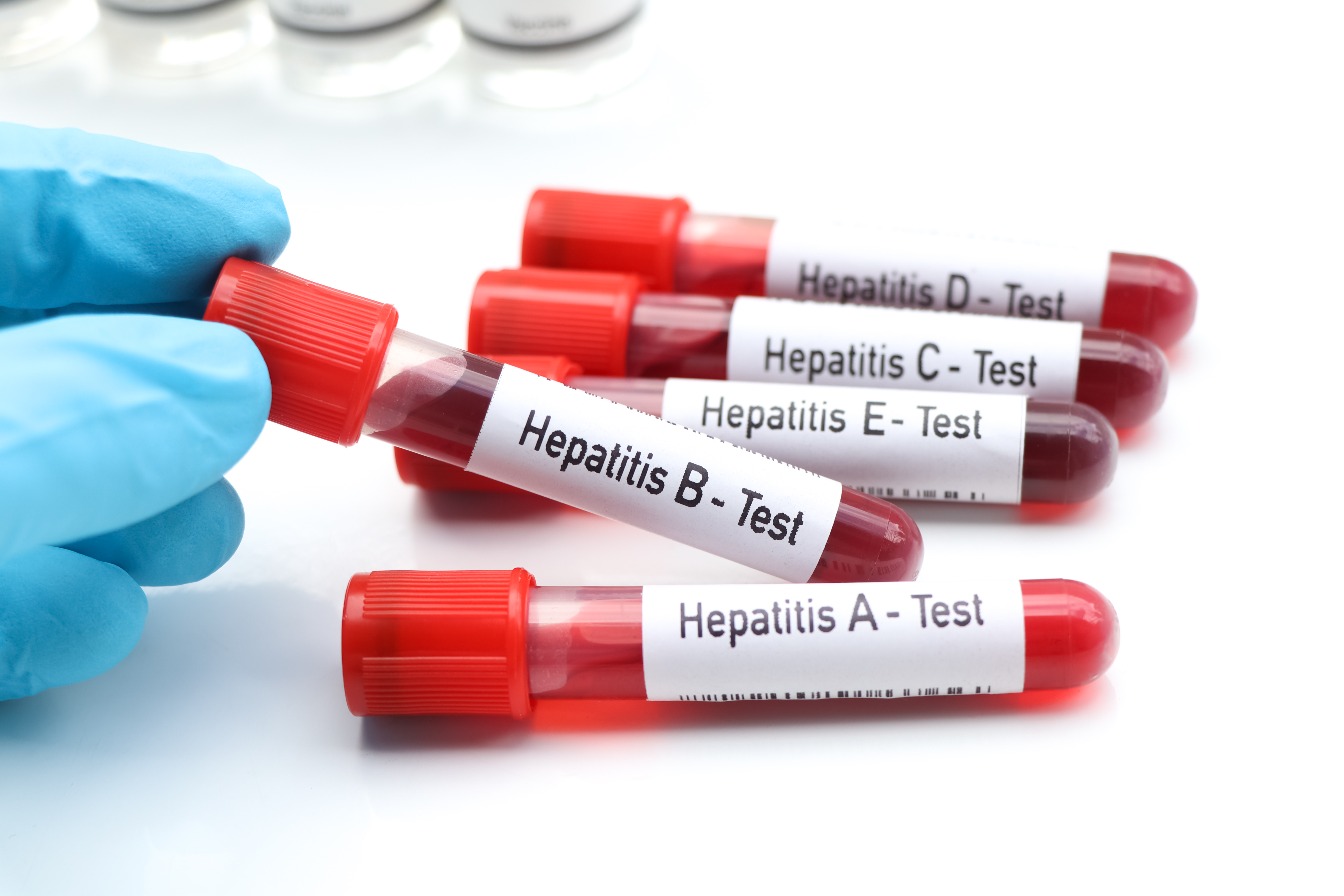 Hepatitis is a contagious virus that affects the liver. Many of those infected don’t have any symptoms.  Photo / Getty Images