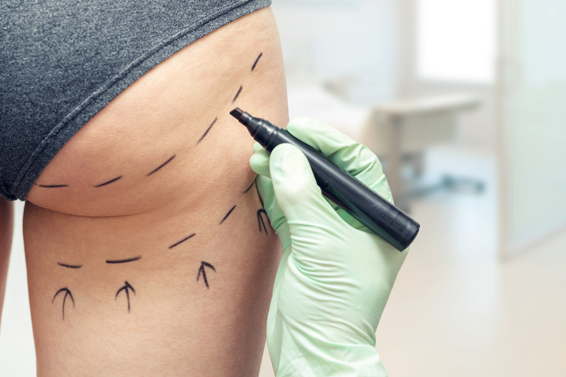 Bodacious butts are in, and operations to get them are too. Photo / Getty Images. 