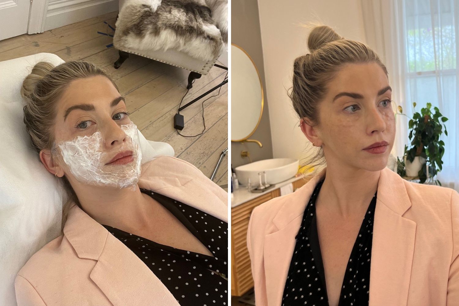 Waiting for the numbing cream to kick in (left). Immediately after my treatment (right). Photos / Ashleigh Cometti