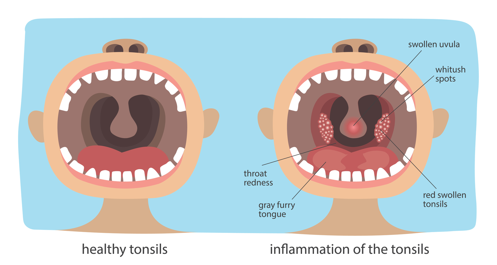 What does an infected throat look like? Photo / 123RF