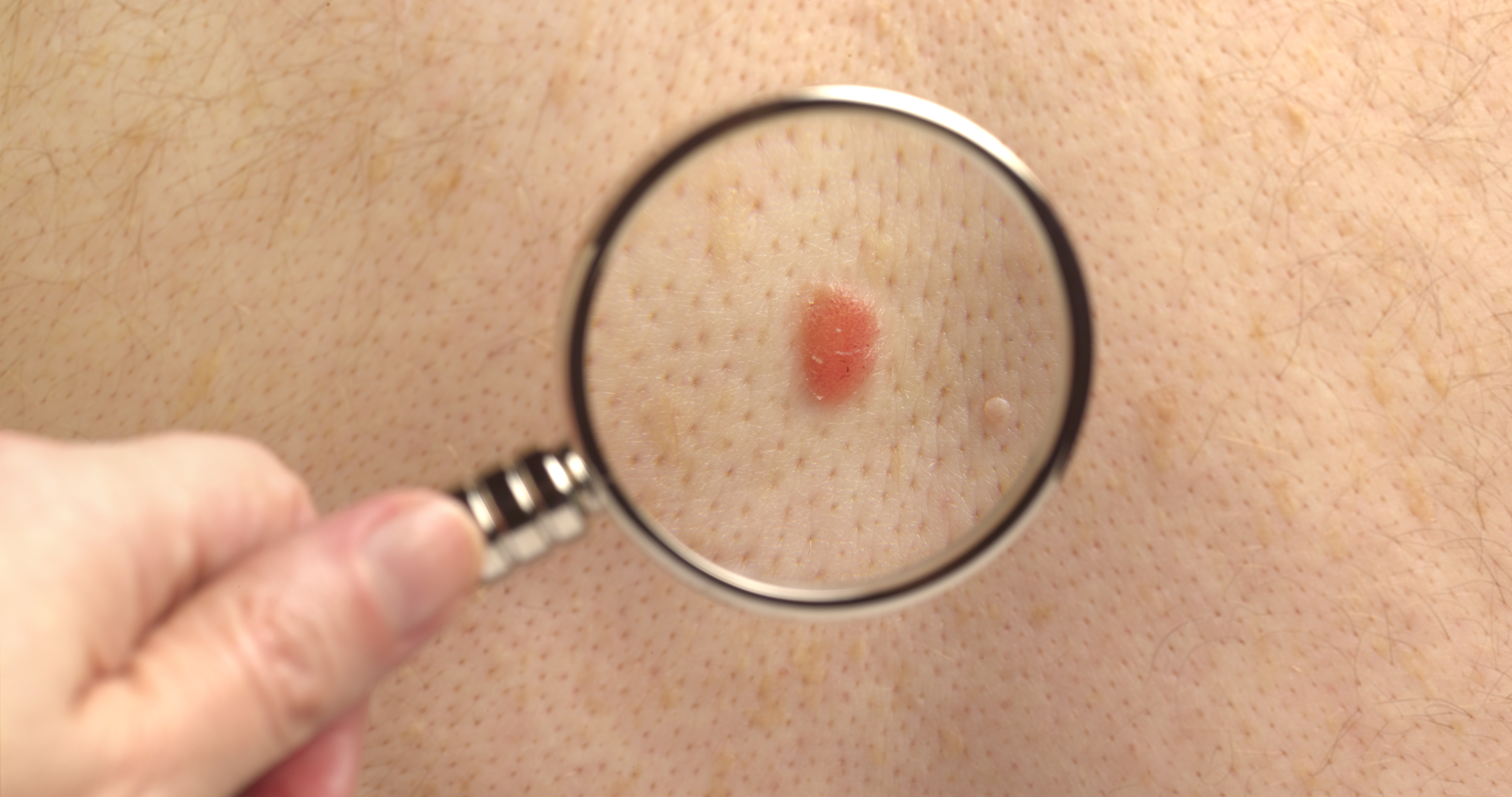 There are four main subtypes of melanoma. Photo / Getty Images