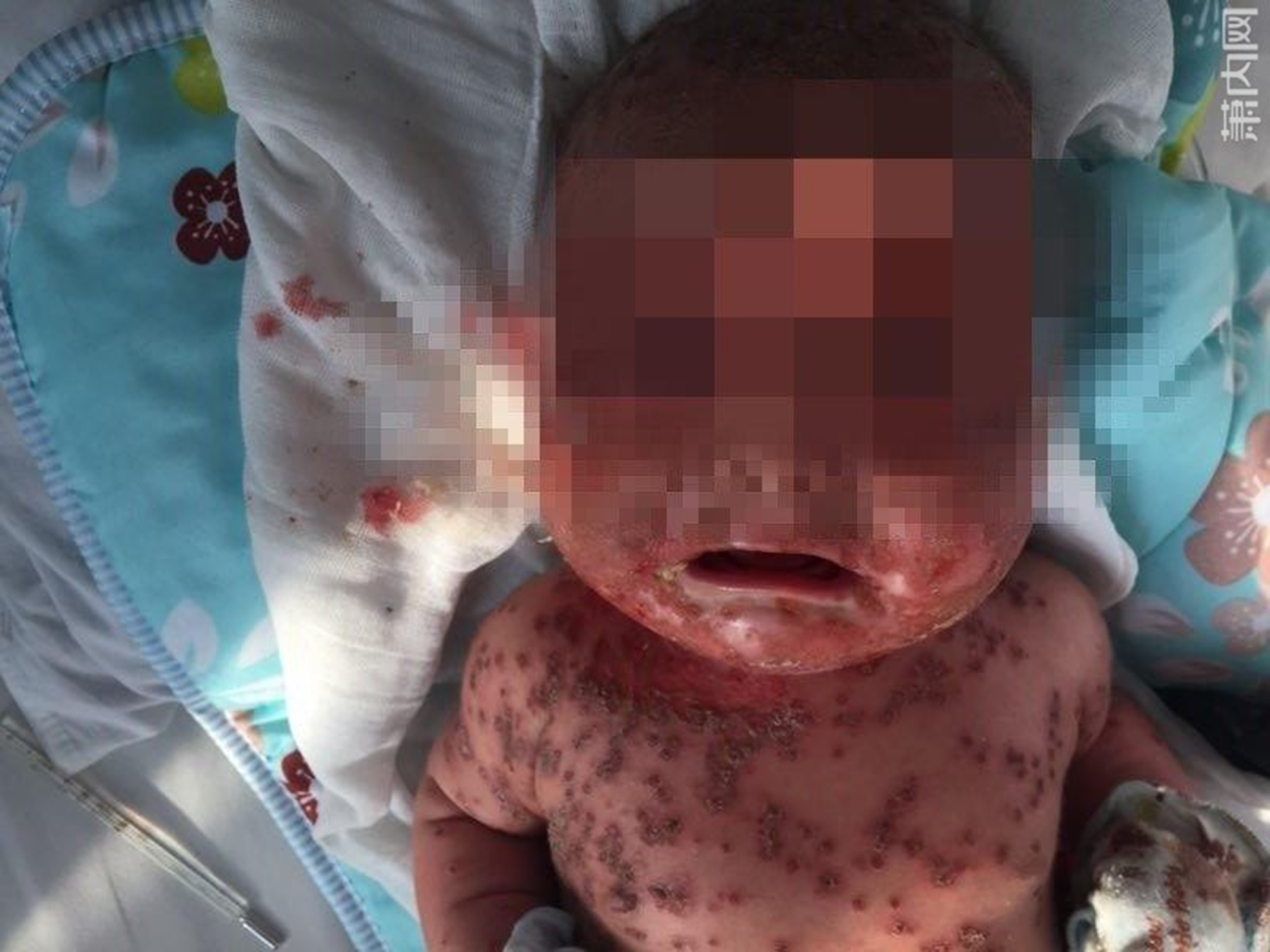 Mum's love leads to baby's horrendous cold sore infection NZ Herald