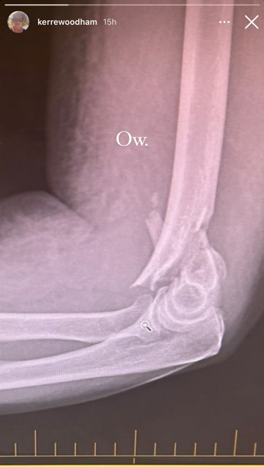 Kerre Woodham shared an x-ray of her shattered arm on her Instagram story. Photo / Instagram, @kerrewoodham
