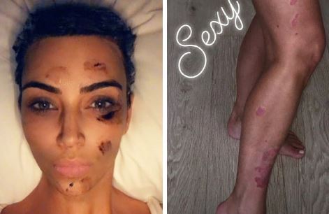 Kim Kardashian has shared how the auto-immune condition has impacted her life. Photos / Instagram