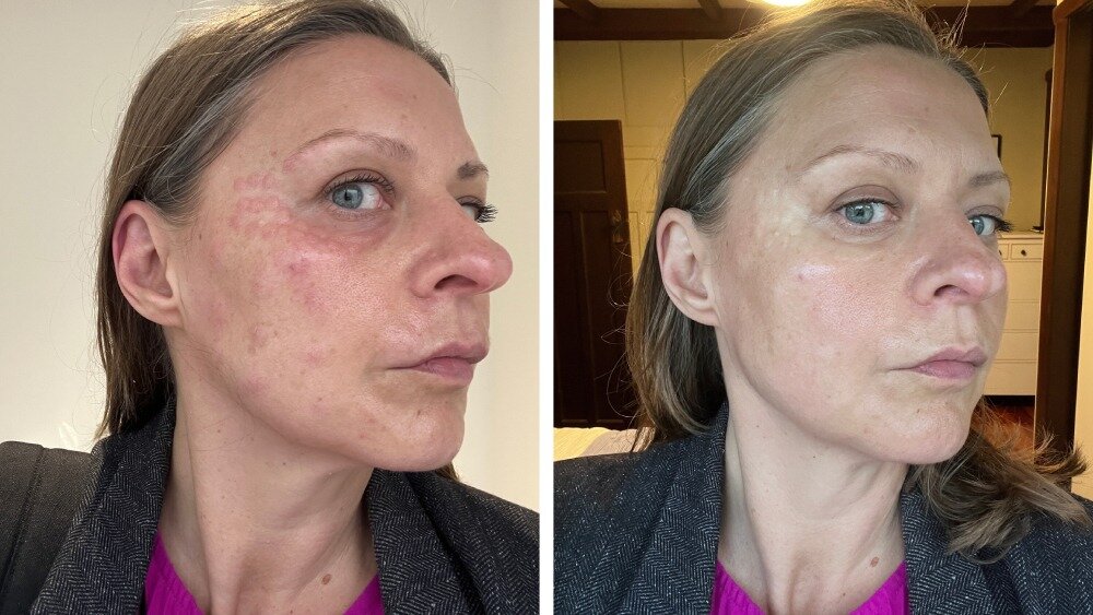 Stephanie Holmes after her first session of Sunekos. The treatment leaves bumps at the injection sites (left) but after 20 minutes (right) the redness has mostly subsided.