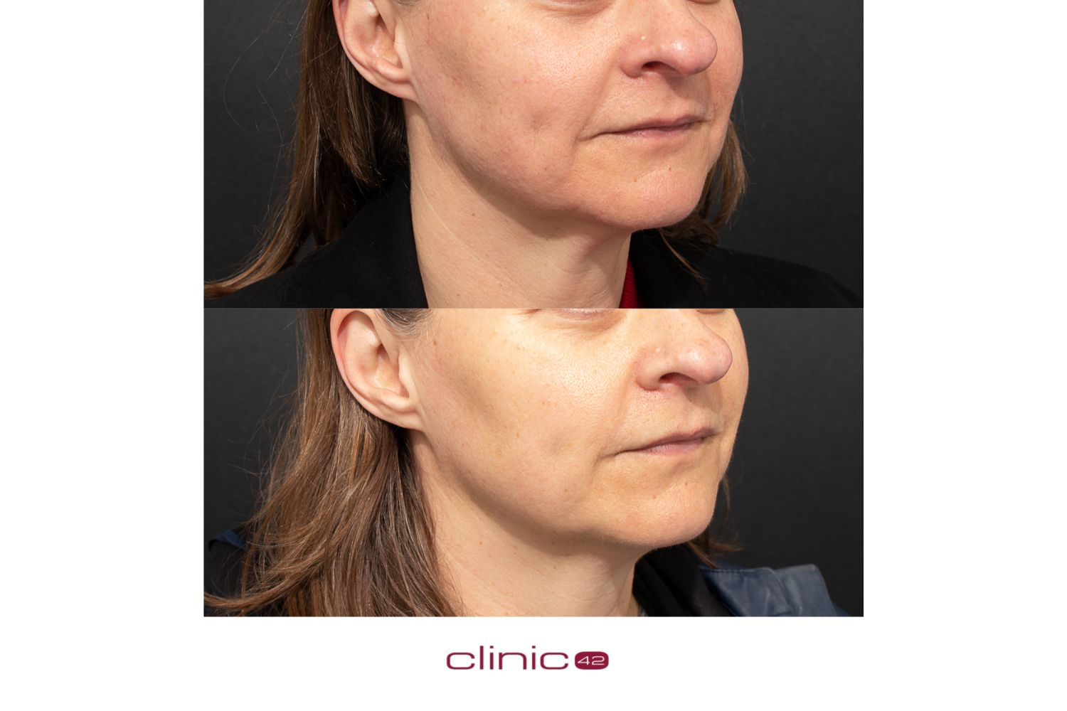 Steph's before (top) and after (below) photos following her two Profhilo Structura treatments at Clinic 42. Photos / Supplied