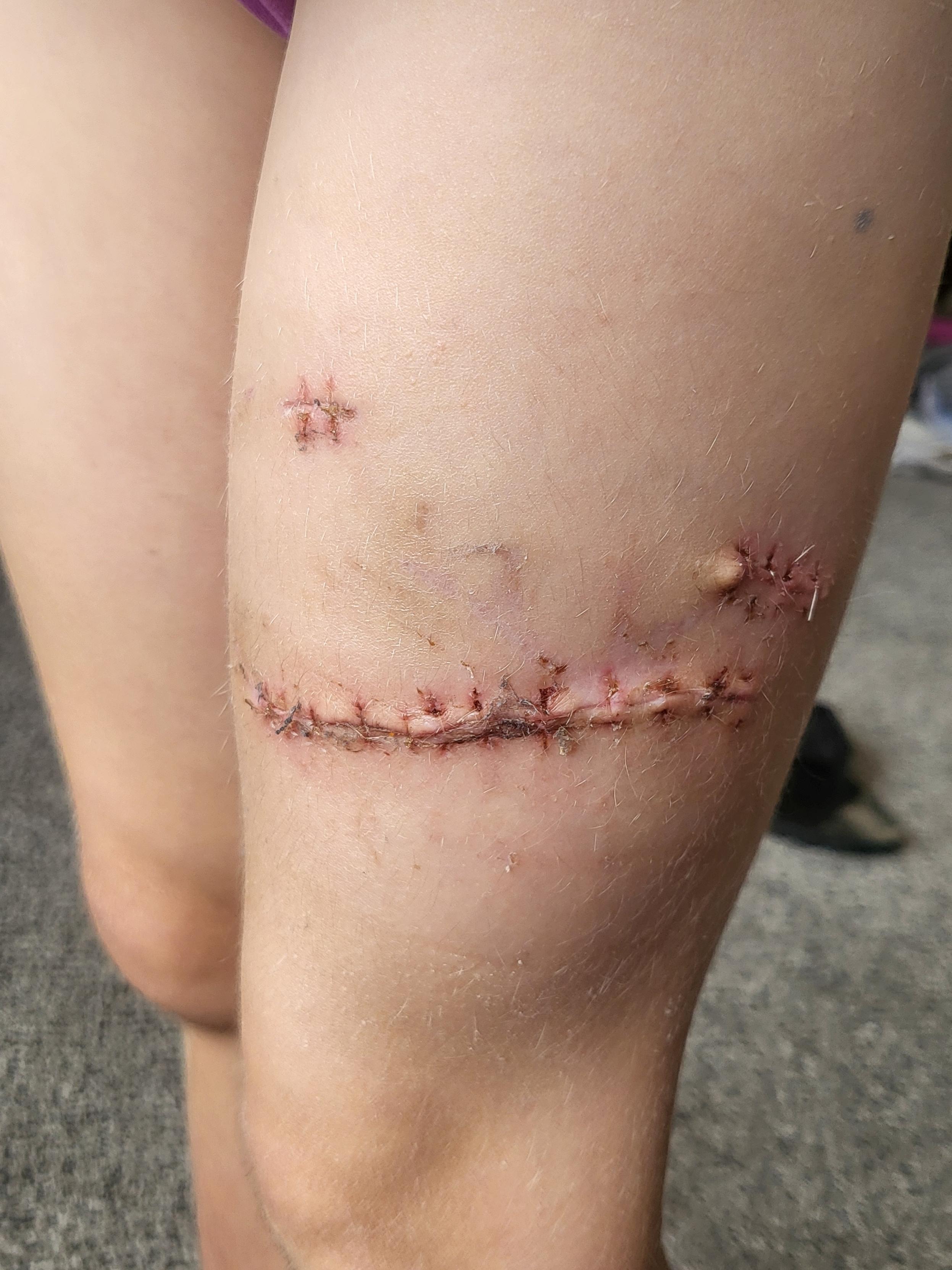 Sienna Lewis' dog bite scars. Photo / Supplied