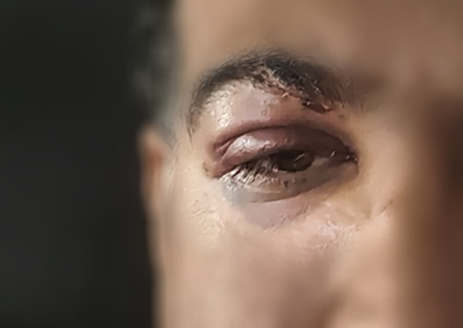 Aaron's stitched up eye a few weeks after the assault. Photo / Supplied