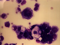 PCNA is essential for cell division – but in a mutated form helps cancer tumours grow.