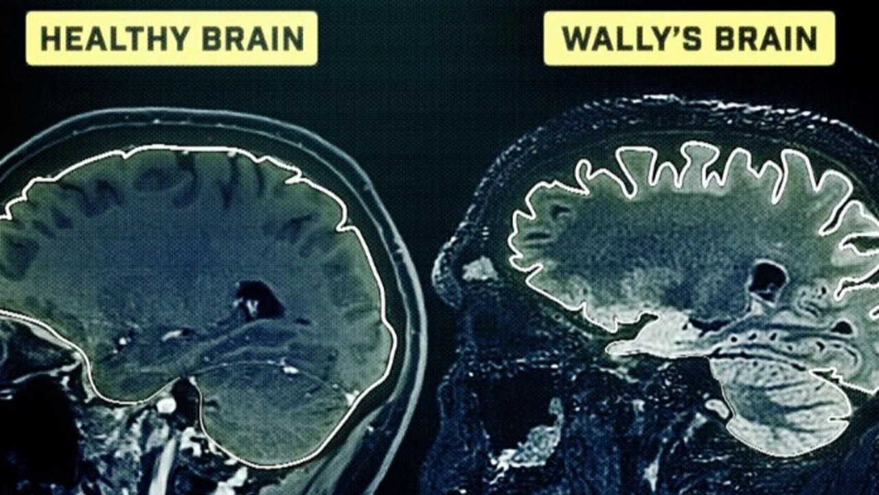 A scan shows the damage to Wally Lewis' brain. Photo / 60 Minutes