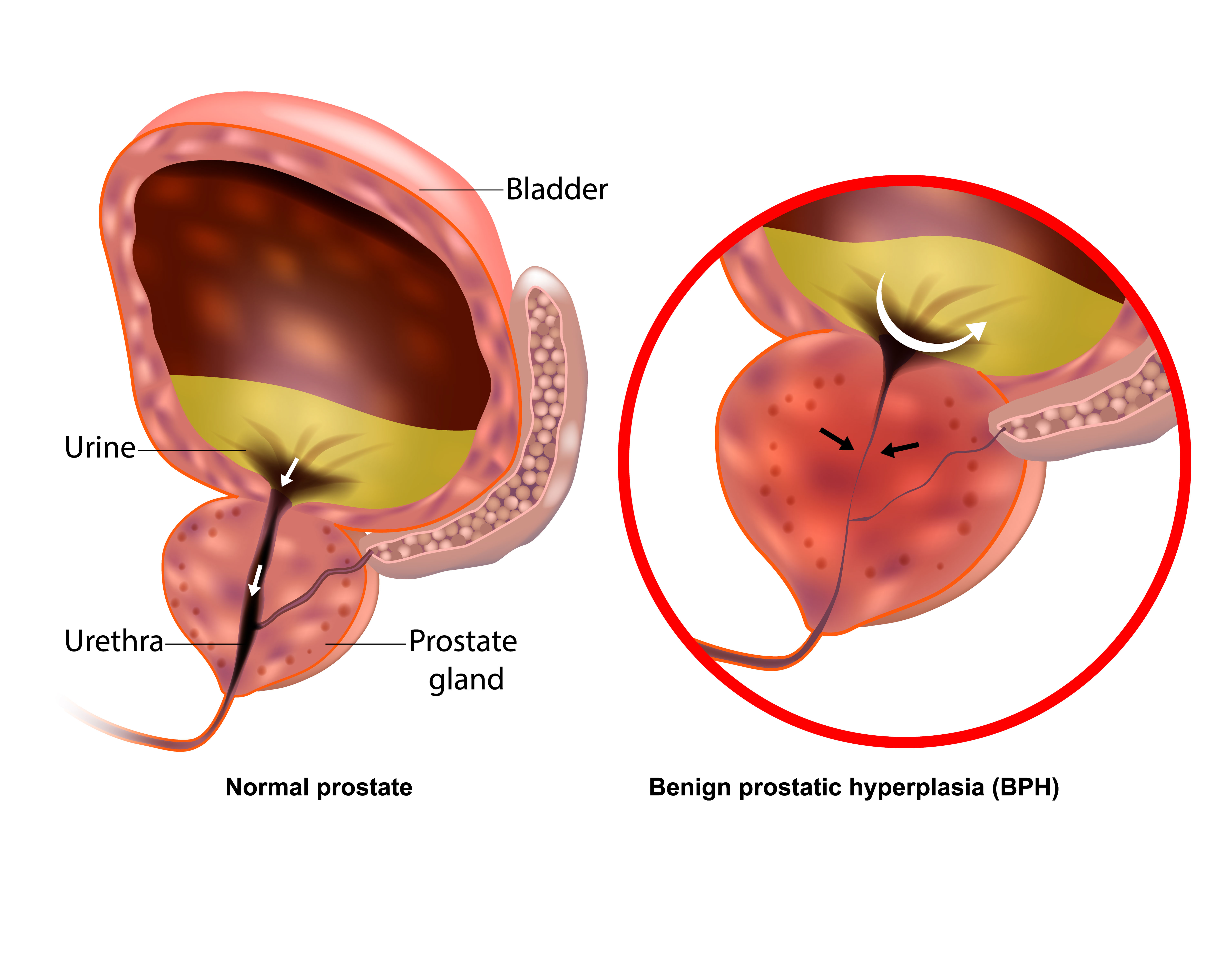 A medical vector illustration showing a normal prostate next to one with benign prostatic hyperplasia (BPH). Photo / Getty Images