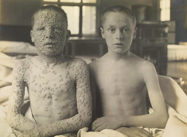 Smallpox and the photos anti-vaxxers don't want you to see - NZ Herald