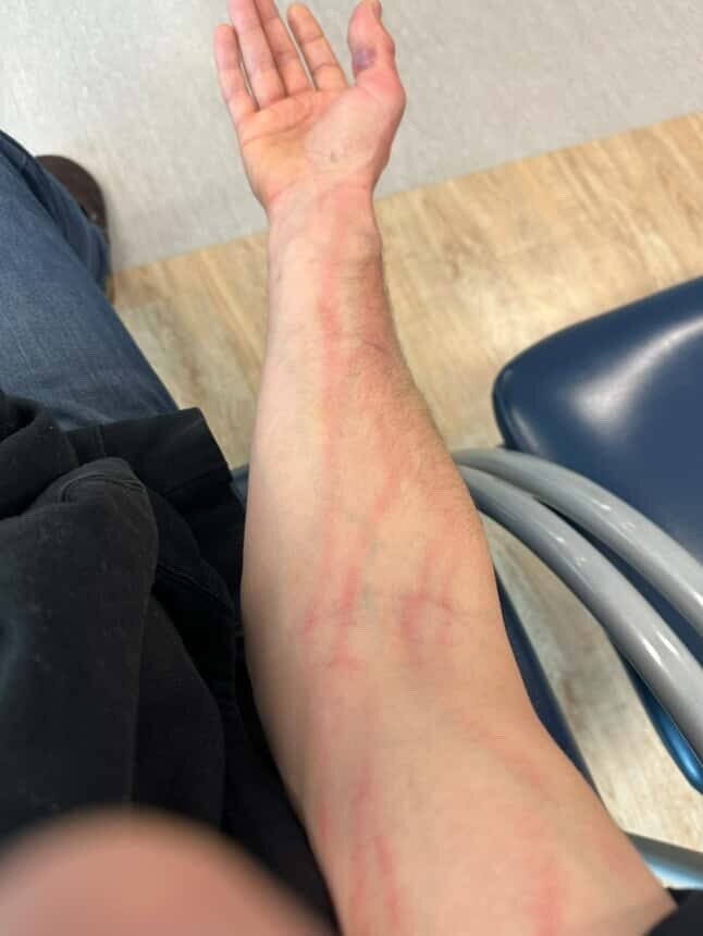 The potentially fatal infection tracking up Auckland chef Phil Clark's arm.
