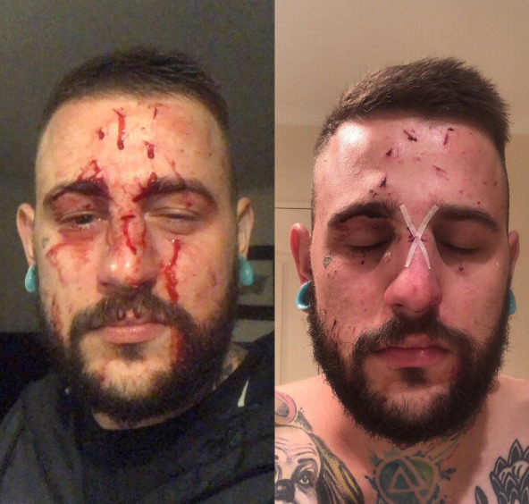 Gareth Noble's injuries shared on Instagram. Photo / Instagram