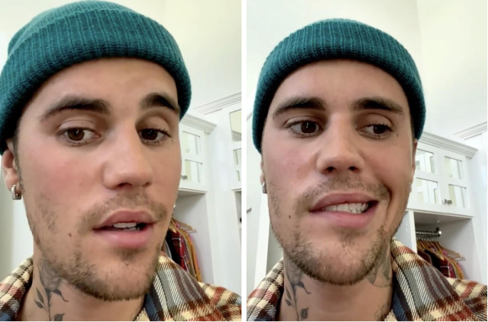 Justin Bieber revealed in a video he has recently been diagnosed with Ramsay Hunt syndrome. Photo/Instagram @justinbieber