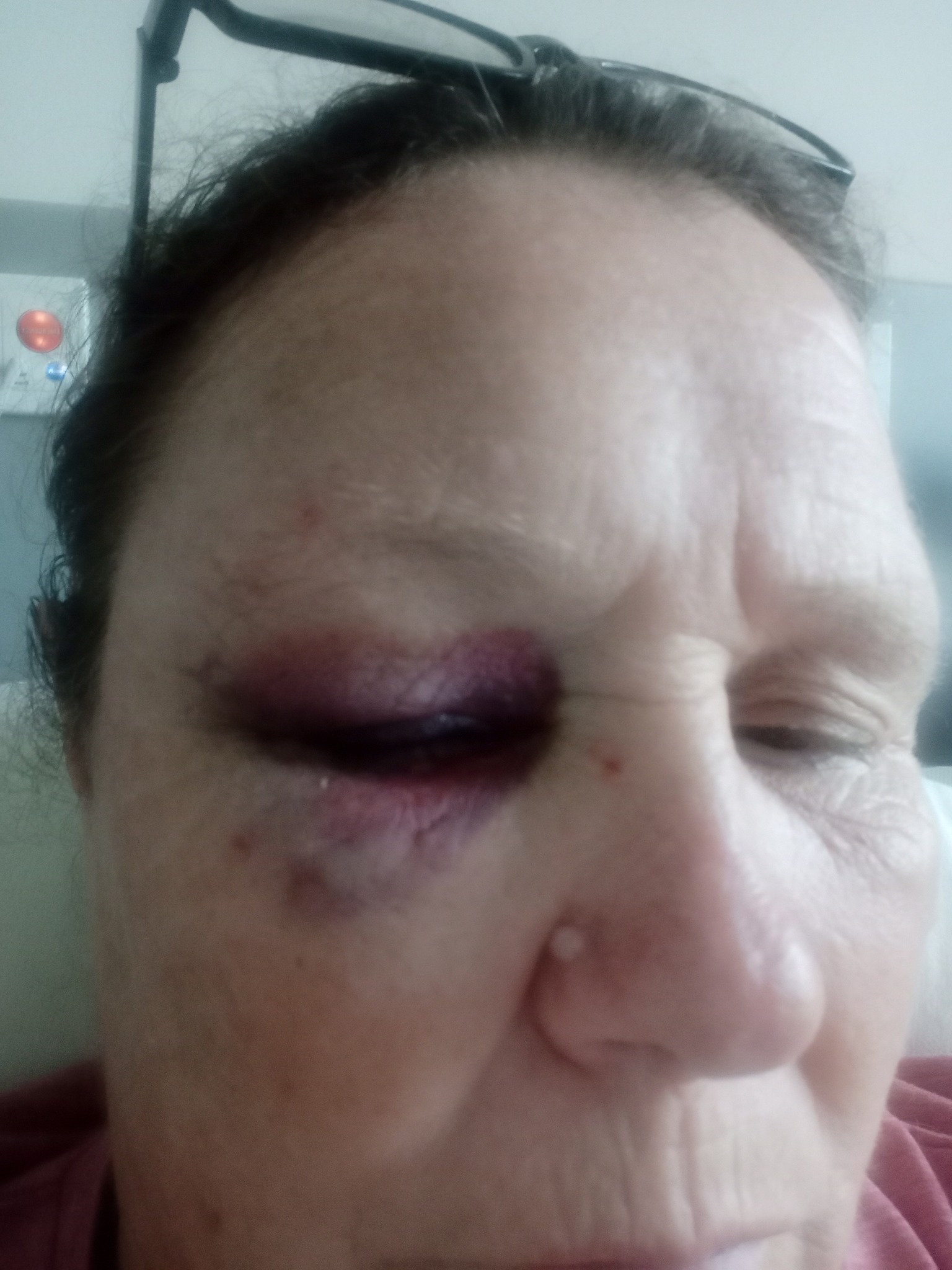 A man spat at and punched Chrissie Massey while she was waiting for treatment at Rawene Clinic in Hokianga on May 18, leaving her with a severely blackened eye.