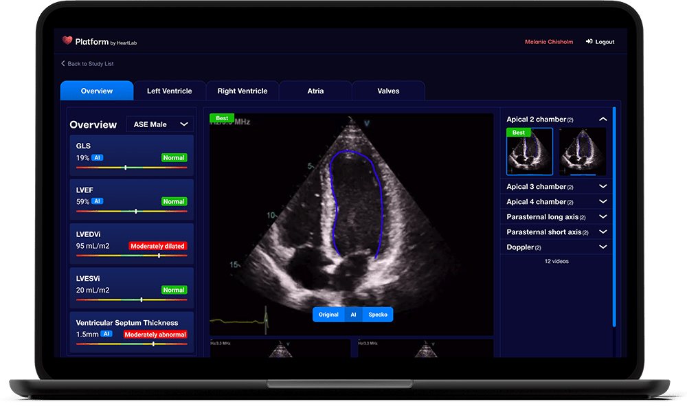 HeartLab's software uses AI technology to enhance speed and accuracy when an echocardiogram scan is analysed. Image / Supplied