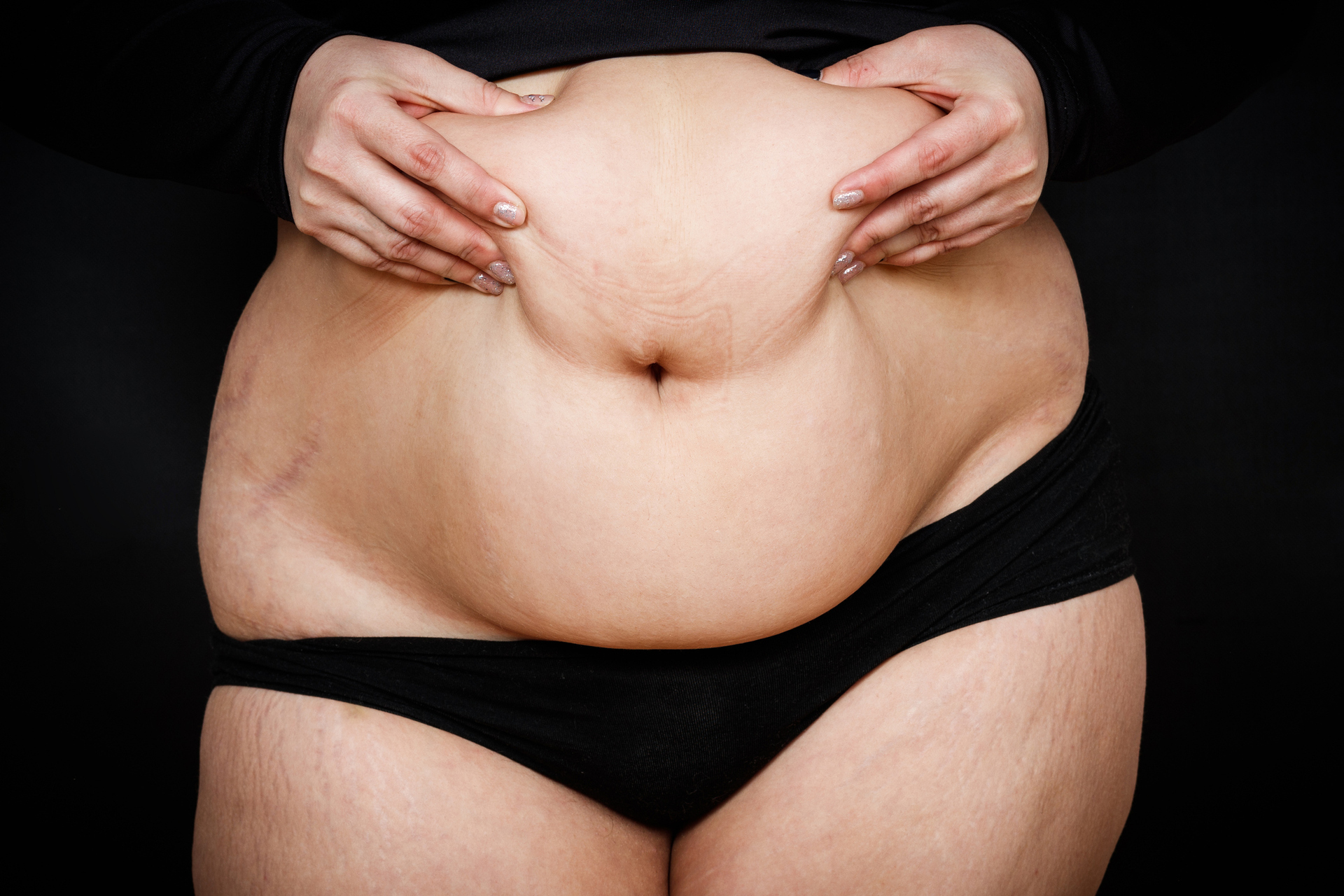 Tummy Tuck Before and After Photos NZ - Dr Mark Gittos Plastic Surgeon