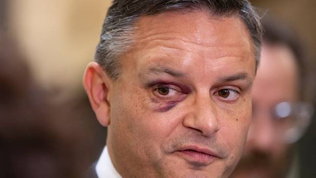James Shaw suffered a broken eye socket in the March 14 attack. Photo / Mark Mitchell