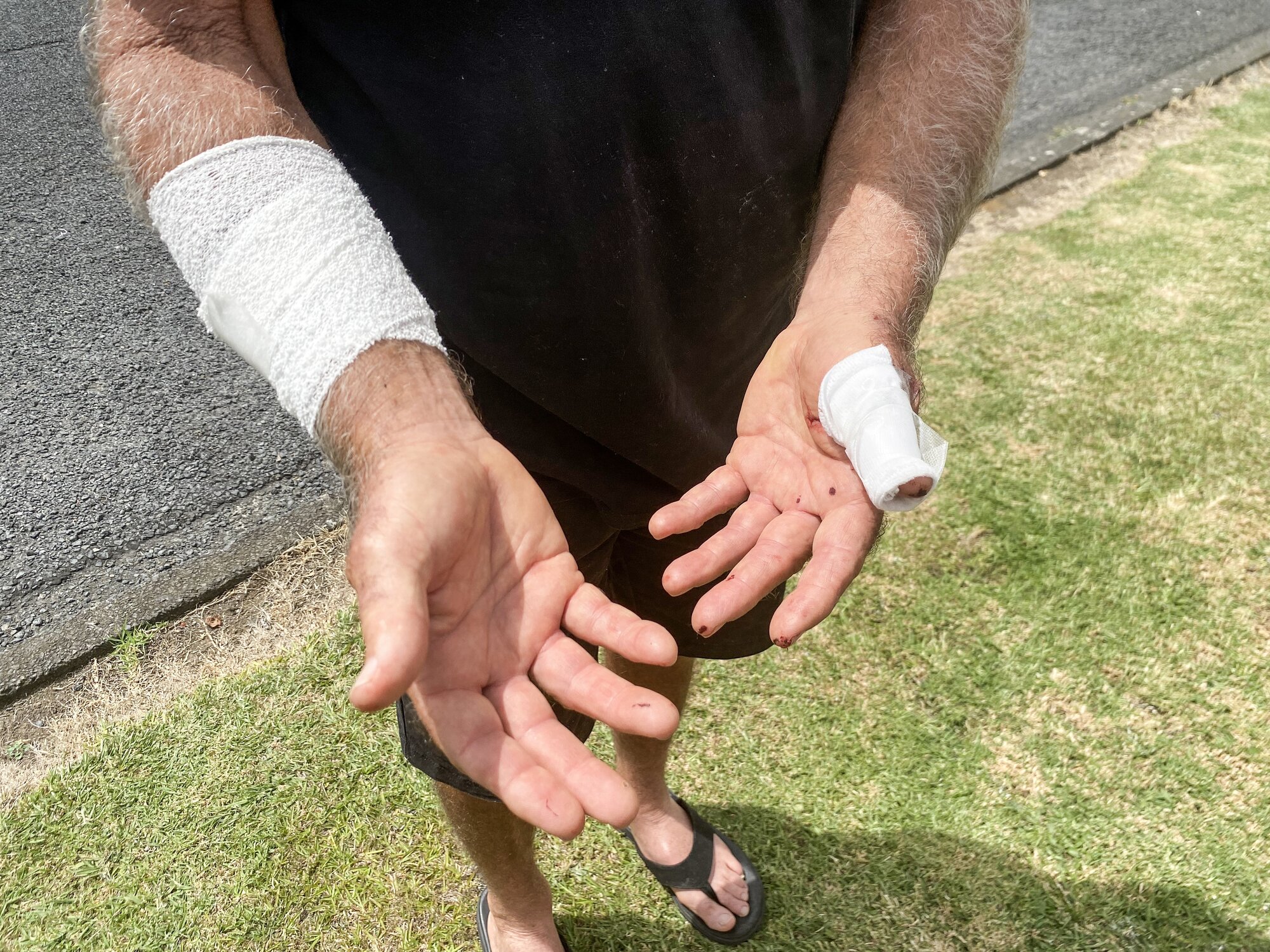 Paul Dore shows his injuries after a dog attack. Photo / Cherie Howie 