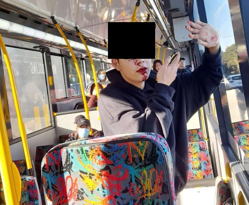 The schoolboy had three teeth knocked out and two more damaged when he was randomly attacked on a bus in Auckland.