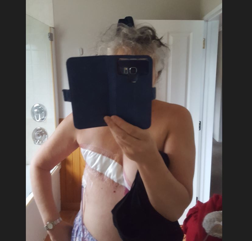 Ali Coomber had a mastectomy after being diagnosed with breast cancer in 2021. Photo / Supplied