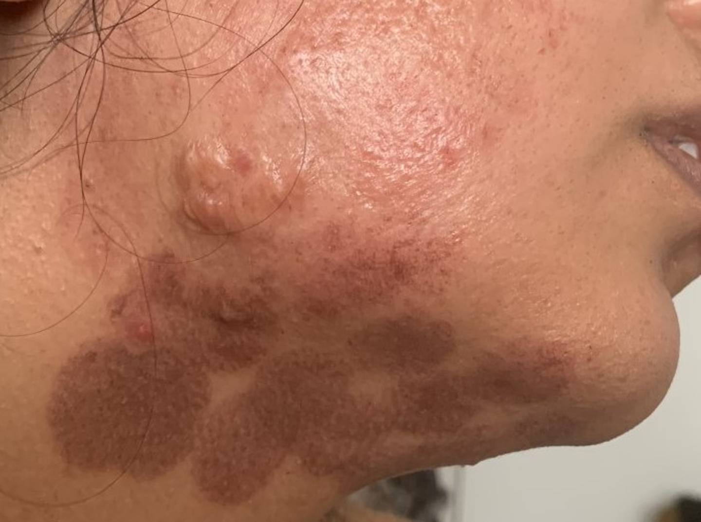 Woman's face burned after Auckland beauty therapist leaves hair removal  laser on wrong settings - NZ Herald