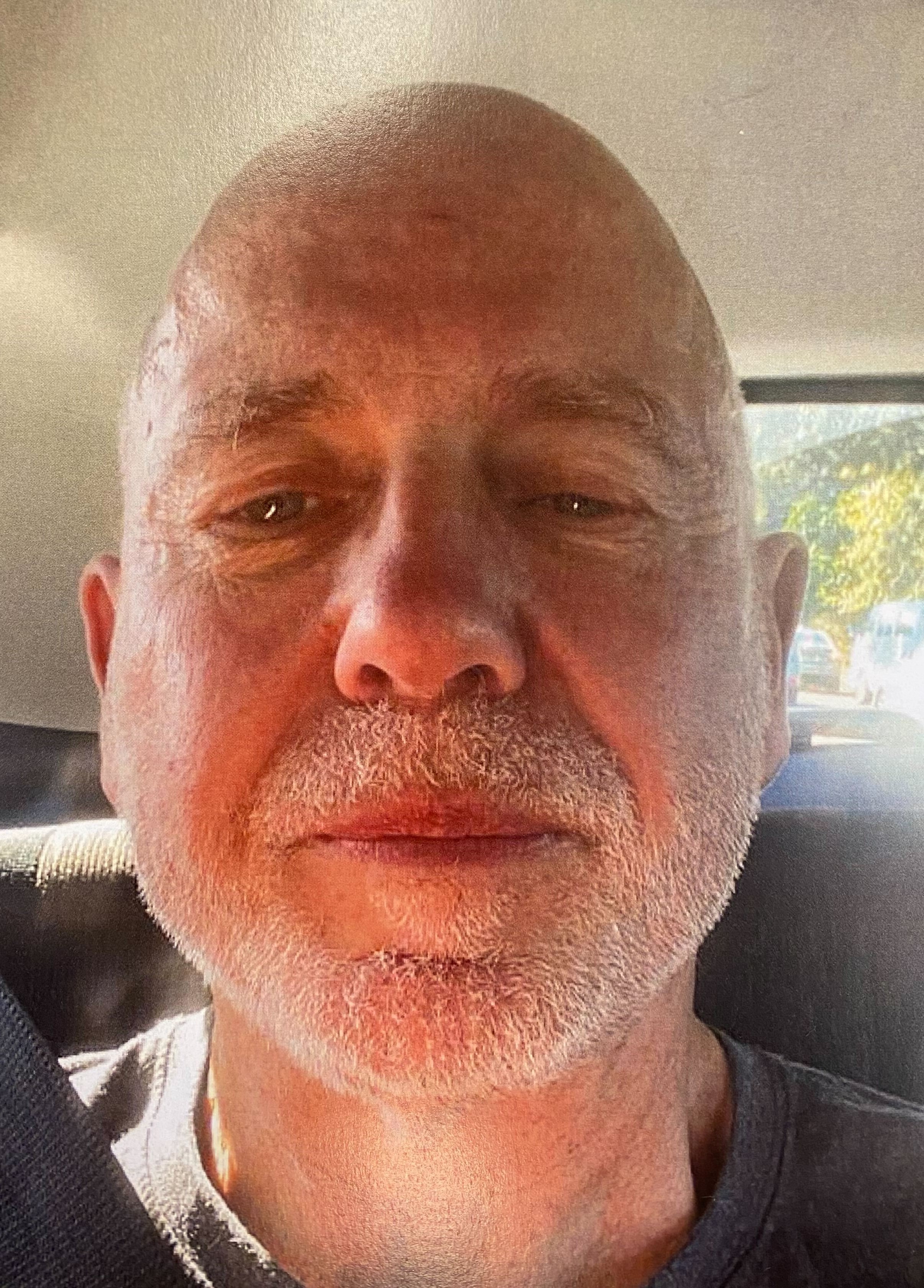 A selfie Dr Philip Polkinghorne sent to escort Madison Ashton on April 11, 2021 - six days after the death of wife Pauline Hanna - shows a small horizontal abrasion on his forehead.
