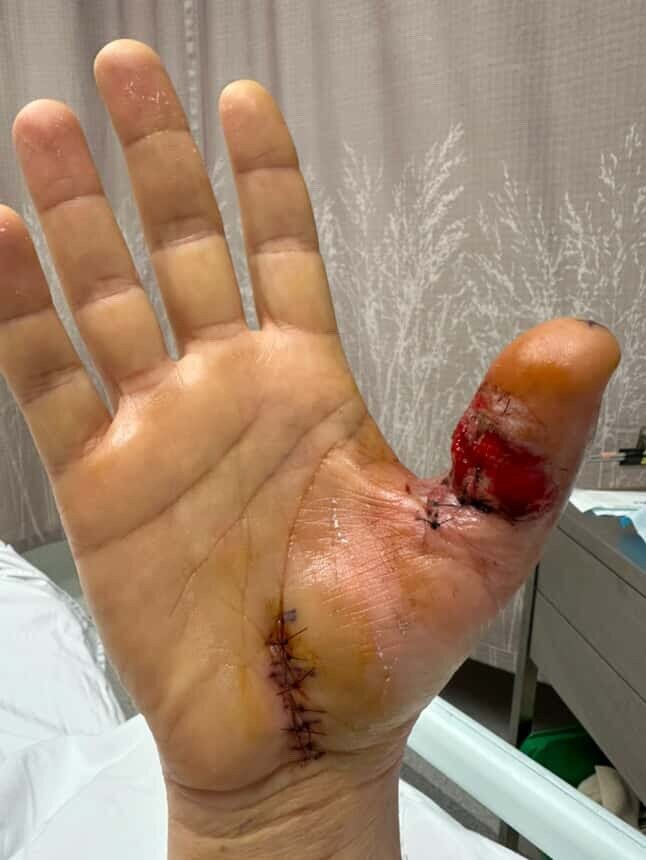 Auckland chef Phil Clark doesn't remember getting the tiny cut on his thumb that led to two major surgeries and an eight-day hospital stay.