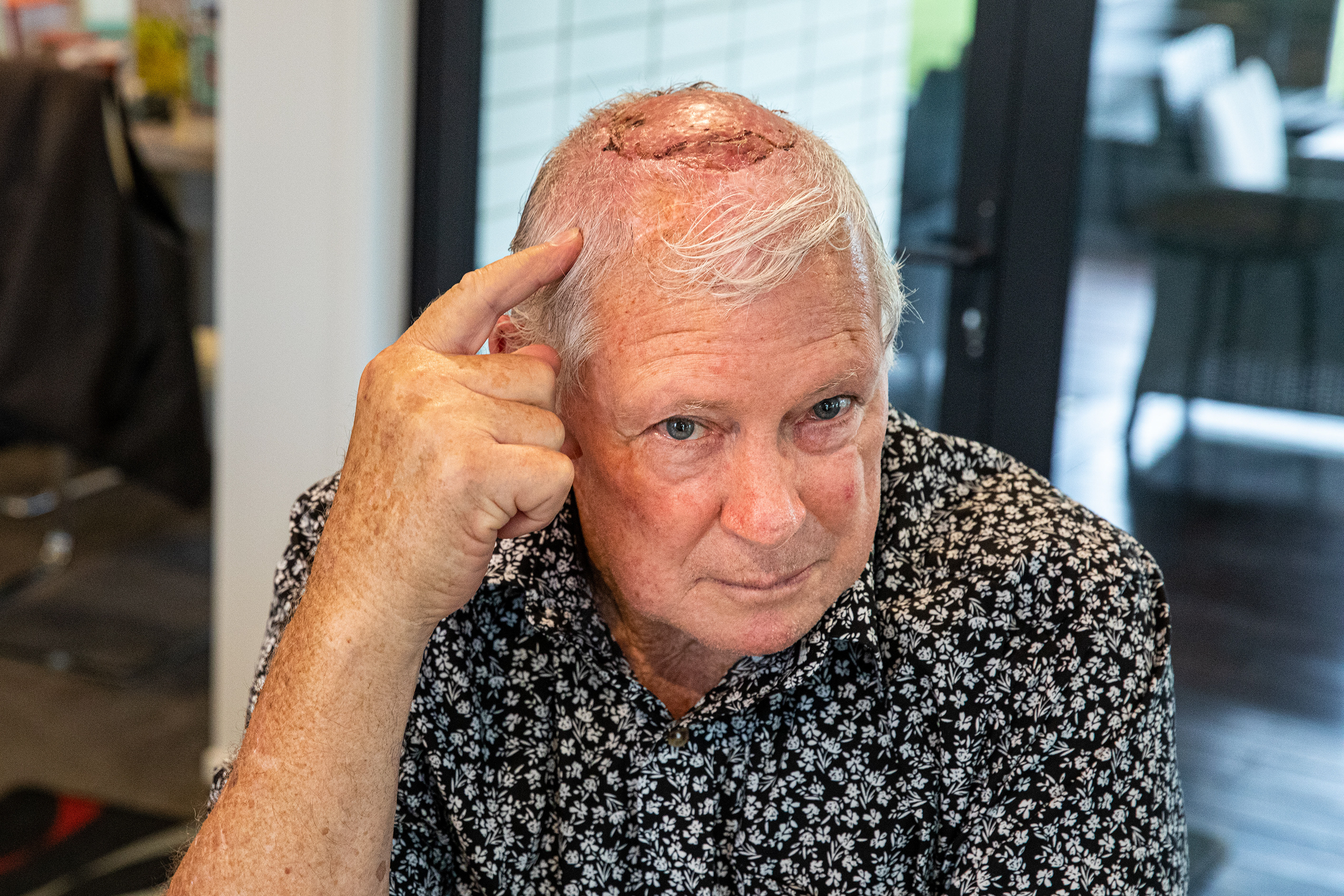 Miles Spence has twice been diagnosed with melanoma in his head. Photo / Mead Norton