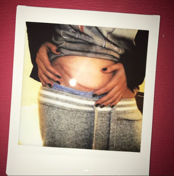 Gomez shared an image of the surgery scar on her Instagram post about the kidney transplant.