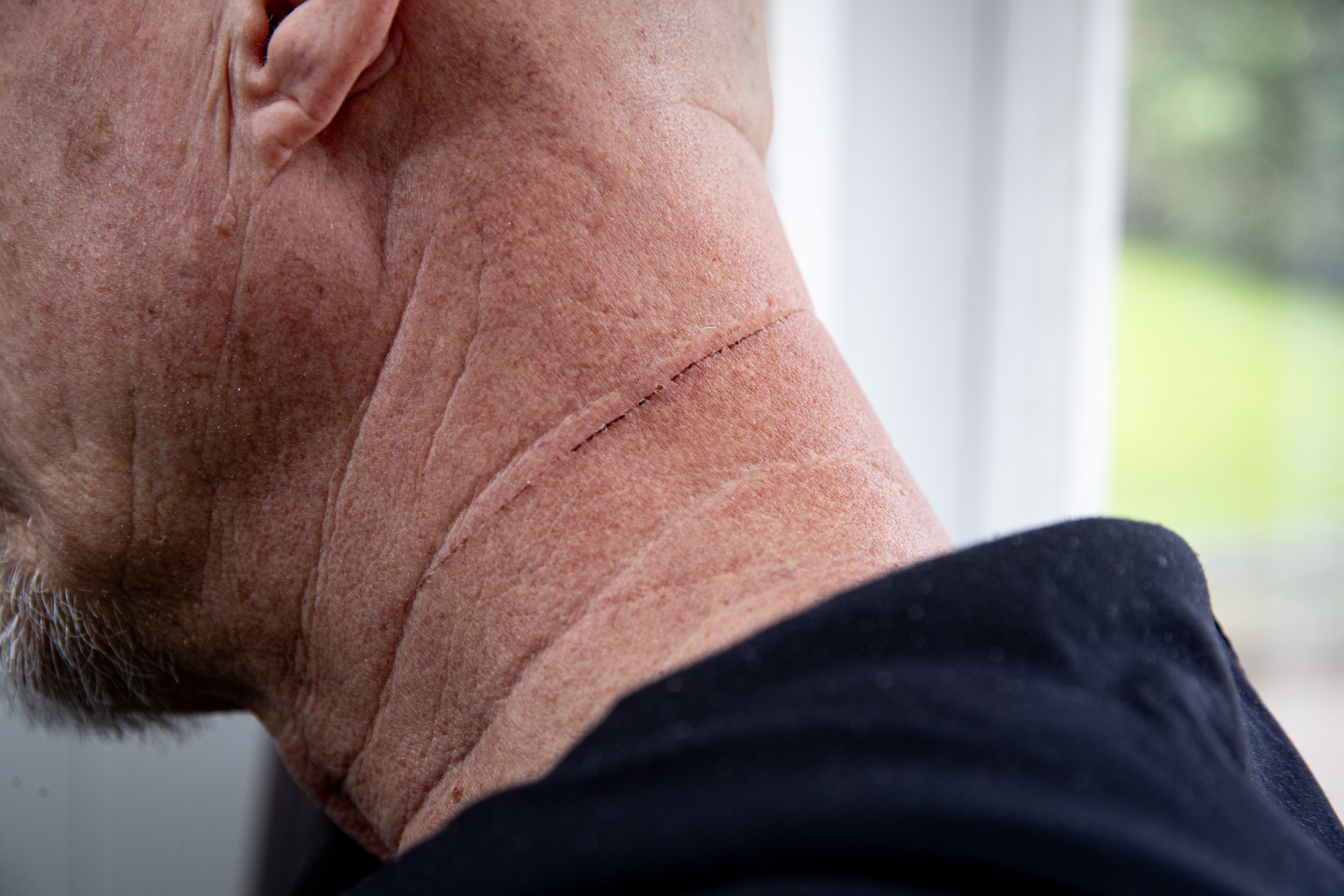 Five days after the attack, the cut was still healing. Photo / Dean Purcell